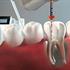درمان روت کانال دندان